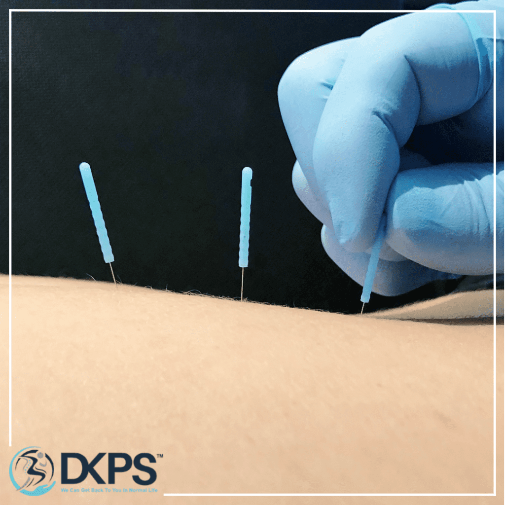 Best Needle therapy in delhi