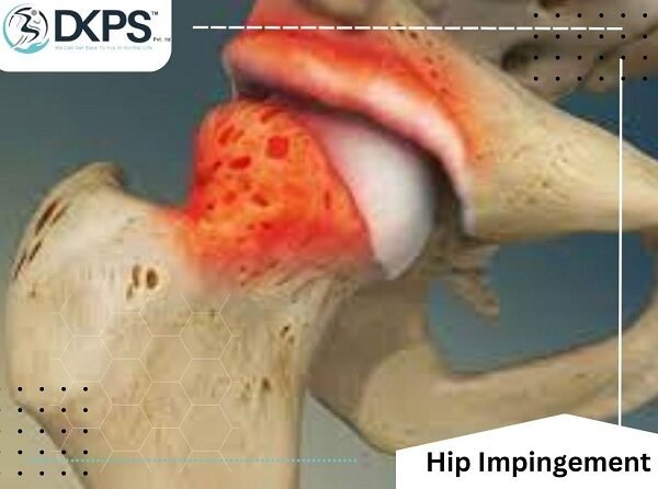 Hip Impingement
