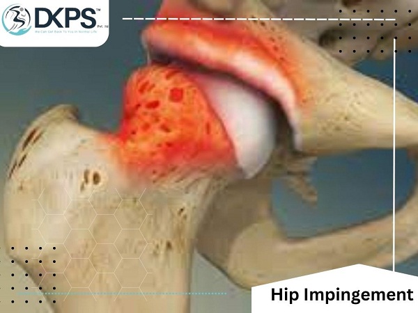 Hip Impingement