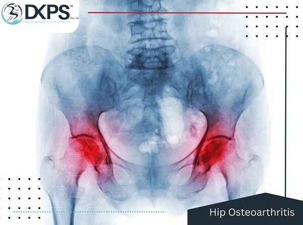 Hip Osteoarthritis