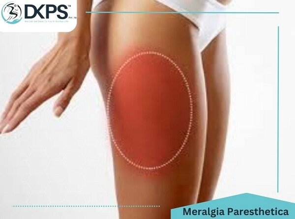 Meralgia Paresthetica