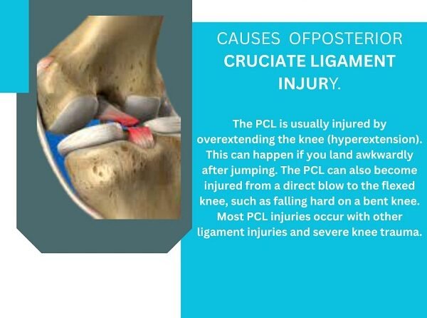 Posterior Cruciate Ligament (PCL) Injury