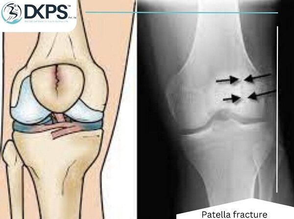Patella Fracture