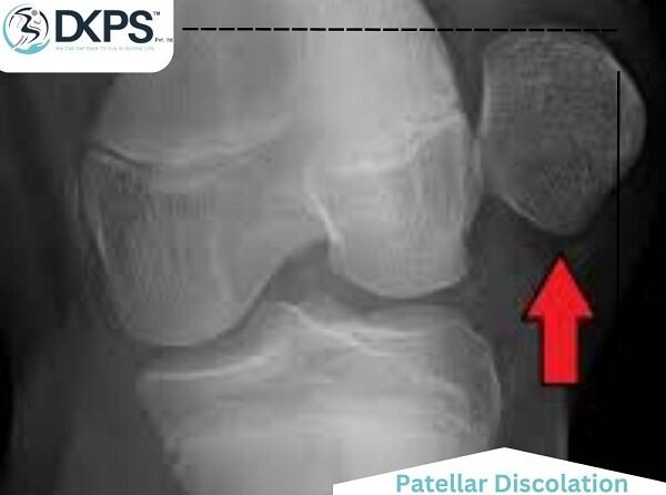 Patella Discolation