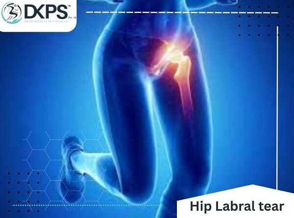Hip Labral Tear