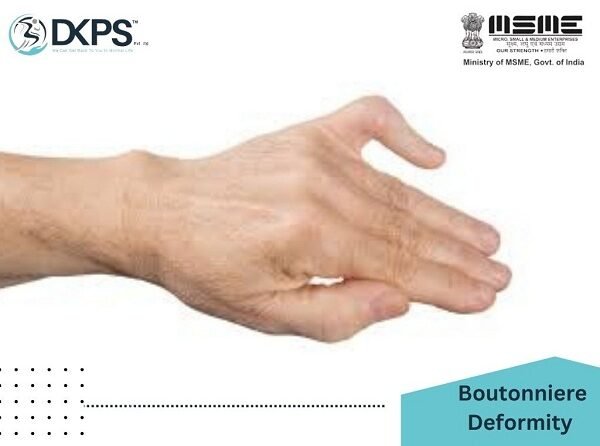 Boutonniere deformity