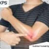 Cubital Tunnel Syndrome