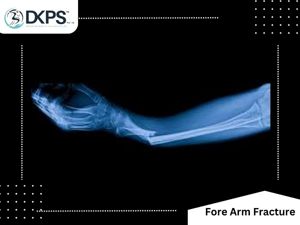 Fore Arm Fracture