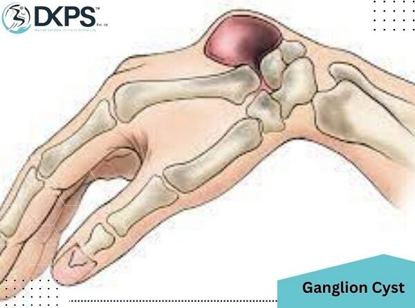 Ganglion Cyst