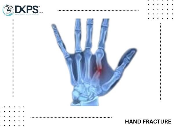 Hand Fracture