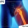 Hip Fracture