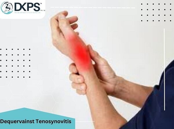 De Quervains tenosynovitis