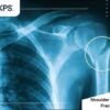 Shoulder And Arm Fractures