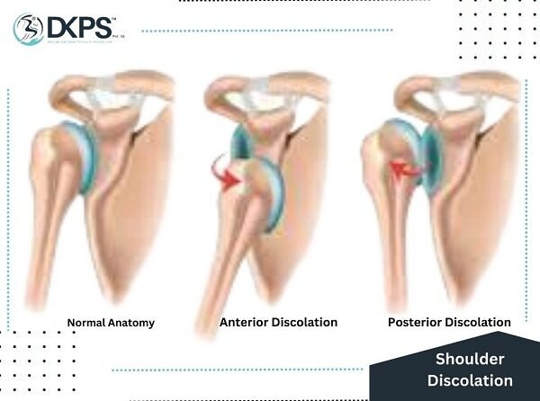 Shoulder Dislocation