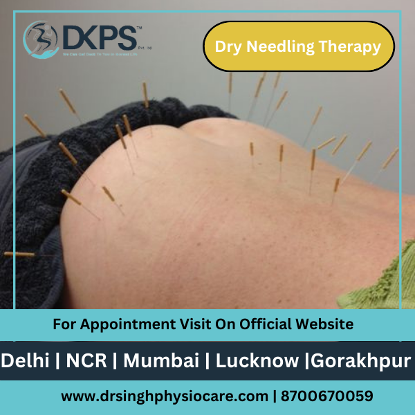 Dry Needling therapy image