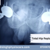 What is Total Hip Replacement (THR)?