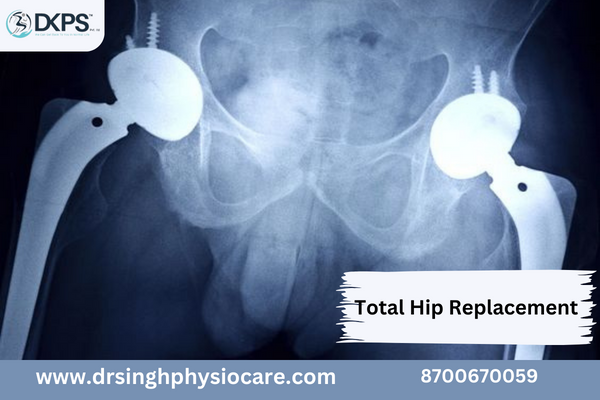 What is Total Hip Replacement (THR)?