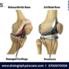What is Total Knee Replacement (TKR) ?