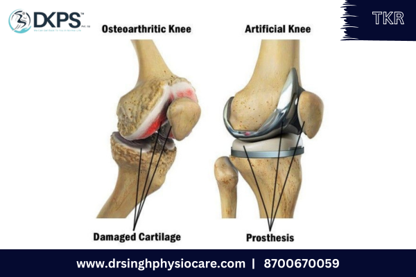 What is Total Knee Replacement (TKR) ?