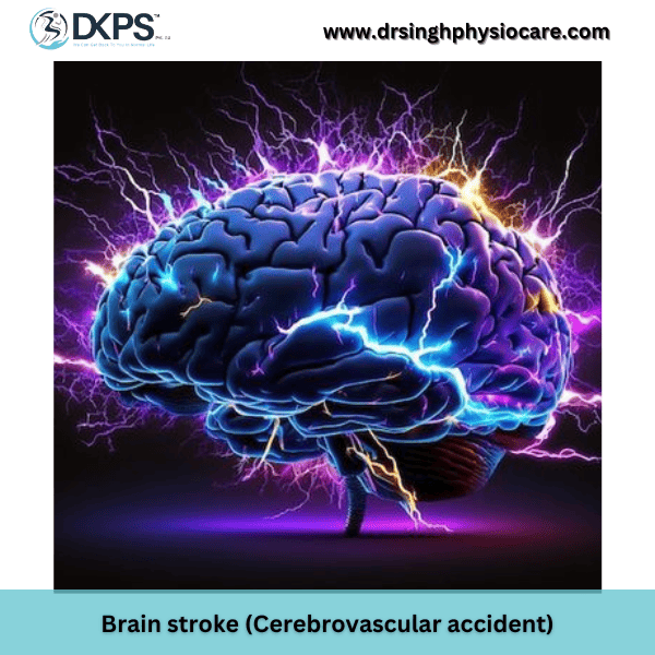 Brain stroke (Cerebro vascular accident)